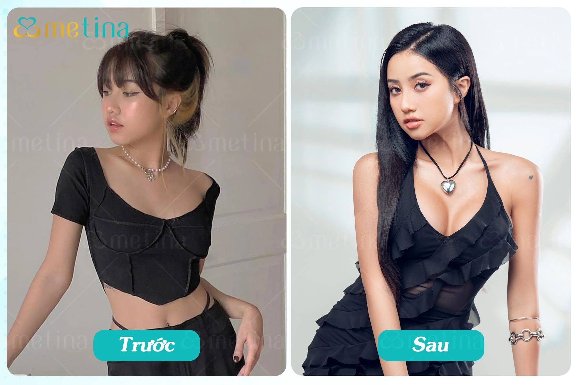 Diễn viên Trịnh Thảo trước và sau khi nâng ngực nội soi tại phòng khám Dr. Châu Thanh Phong - Dr. Châu Thanh Phong - Thẩm mỹ 3 vòng