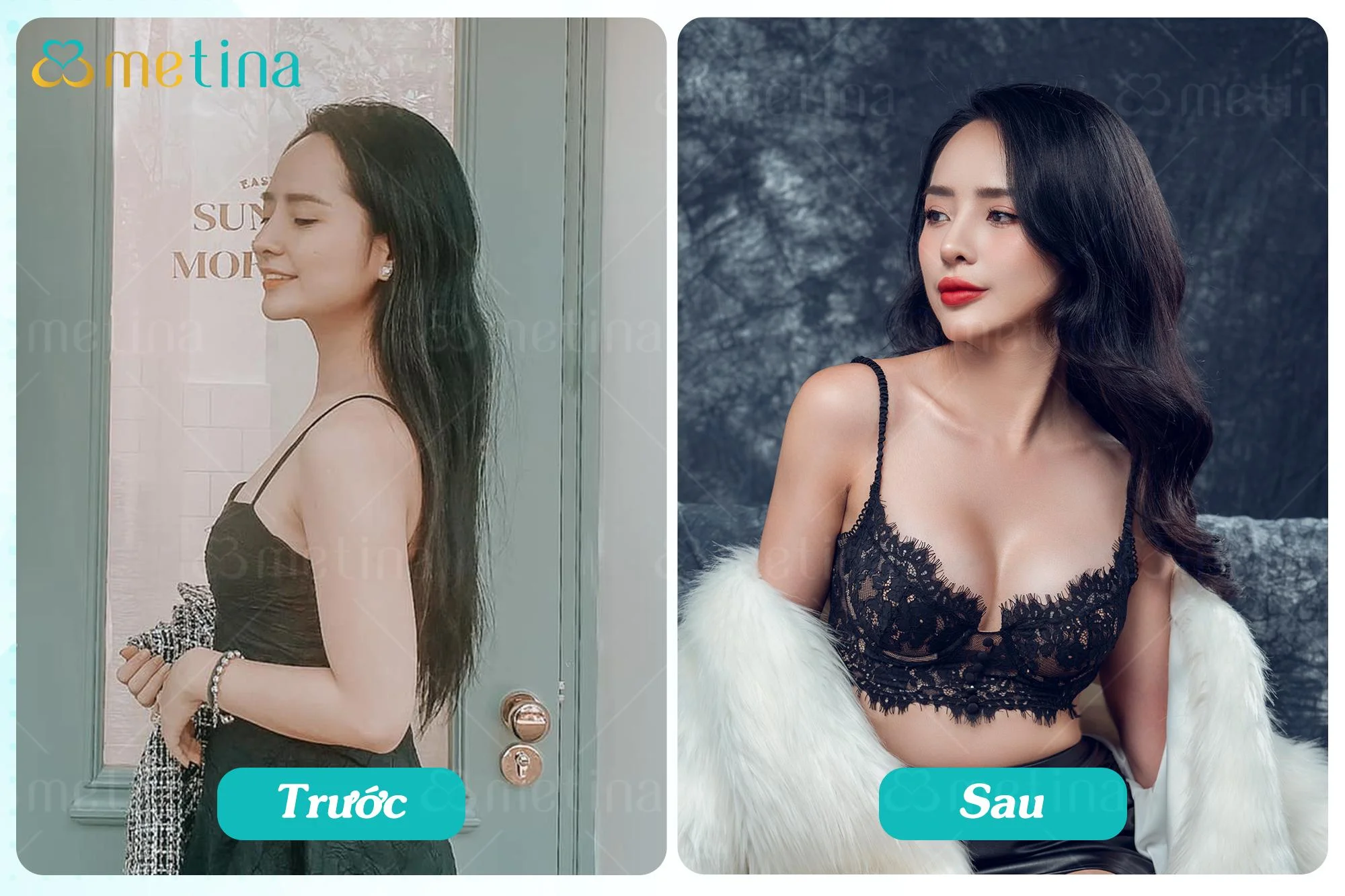 Khách hàng M.H. đã có thể tập gym nhẹ nhàng từ ngày 10 sau nâng ngực nội soi - Dr. Châu Thanh Phong - Thẩm mỹ 3 vòng