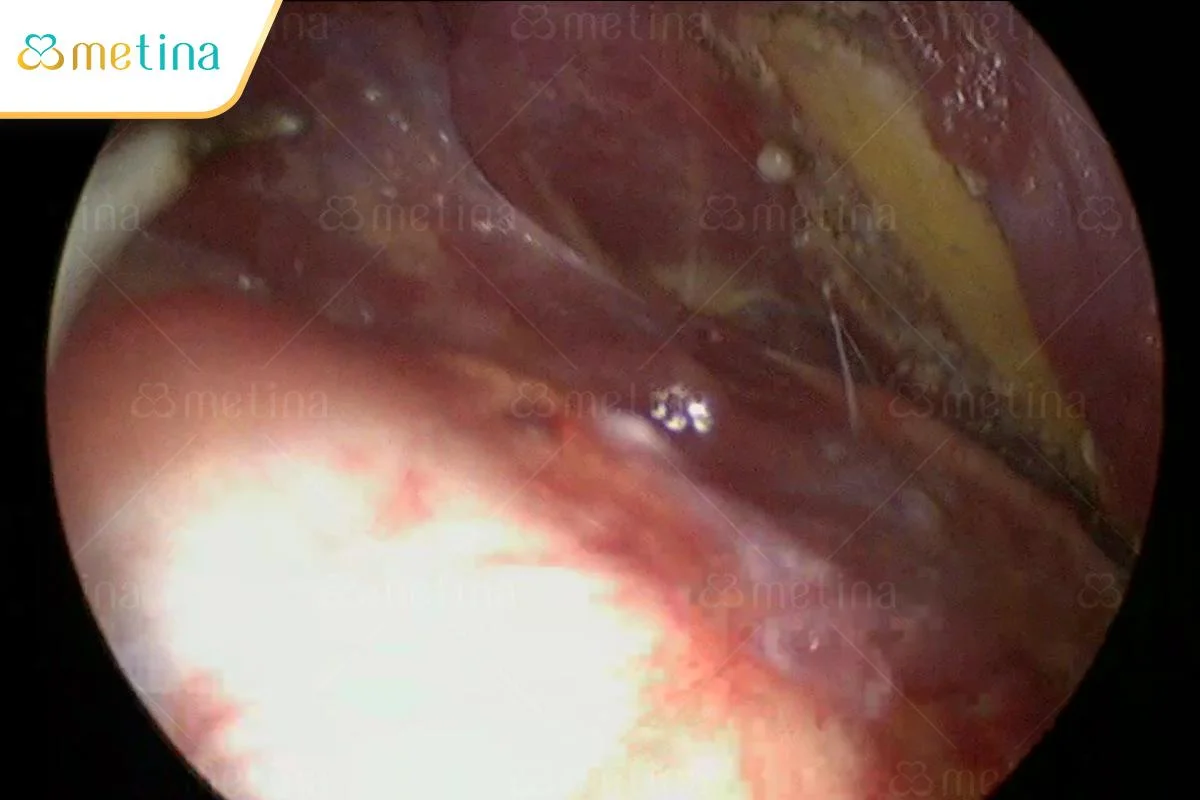 Hình ảnh bên trong ngực được phóng đại để bác sĩ dễ bóc tách tạo khoang - Dr. Châu Thanh Phong - Thẩm mỹ 3 vòng
