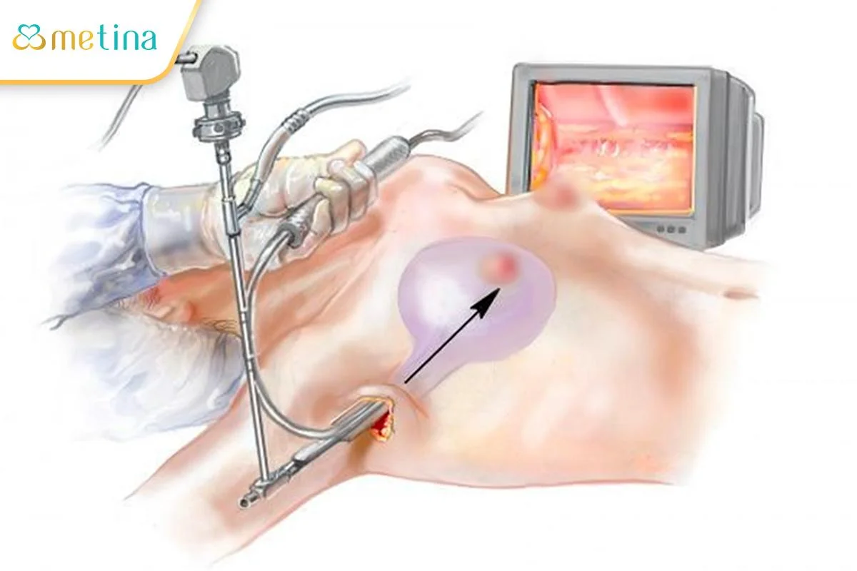 Nâng ngực nội soi sử dụng thiết bị chuyên dụng có gắn camera để đưa vào khoan... - Dr. Châu Thanh Phong - Thẩm mỹ 3 vòng