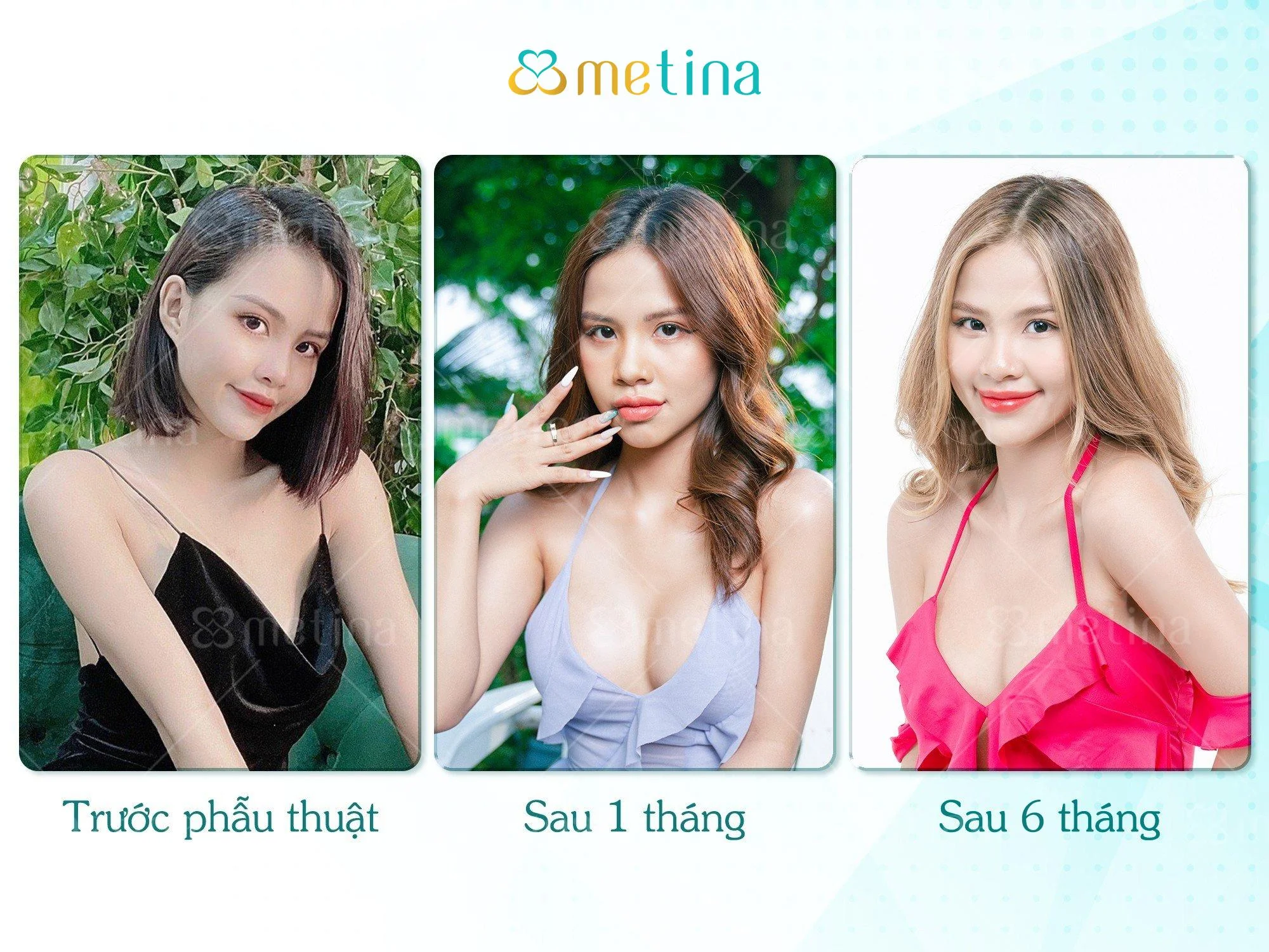Hình ảnh sau 6 tháng phẫu thuật nâng ngực nội soi của KOC GiGi