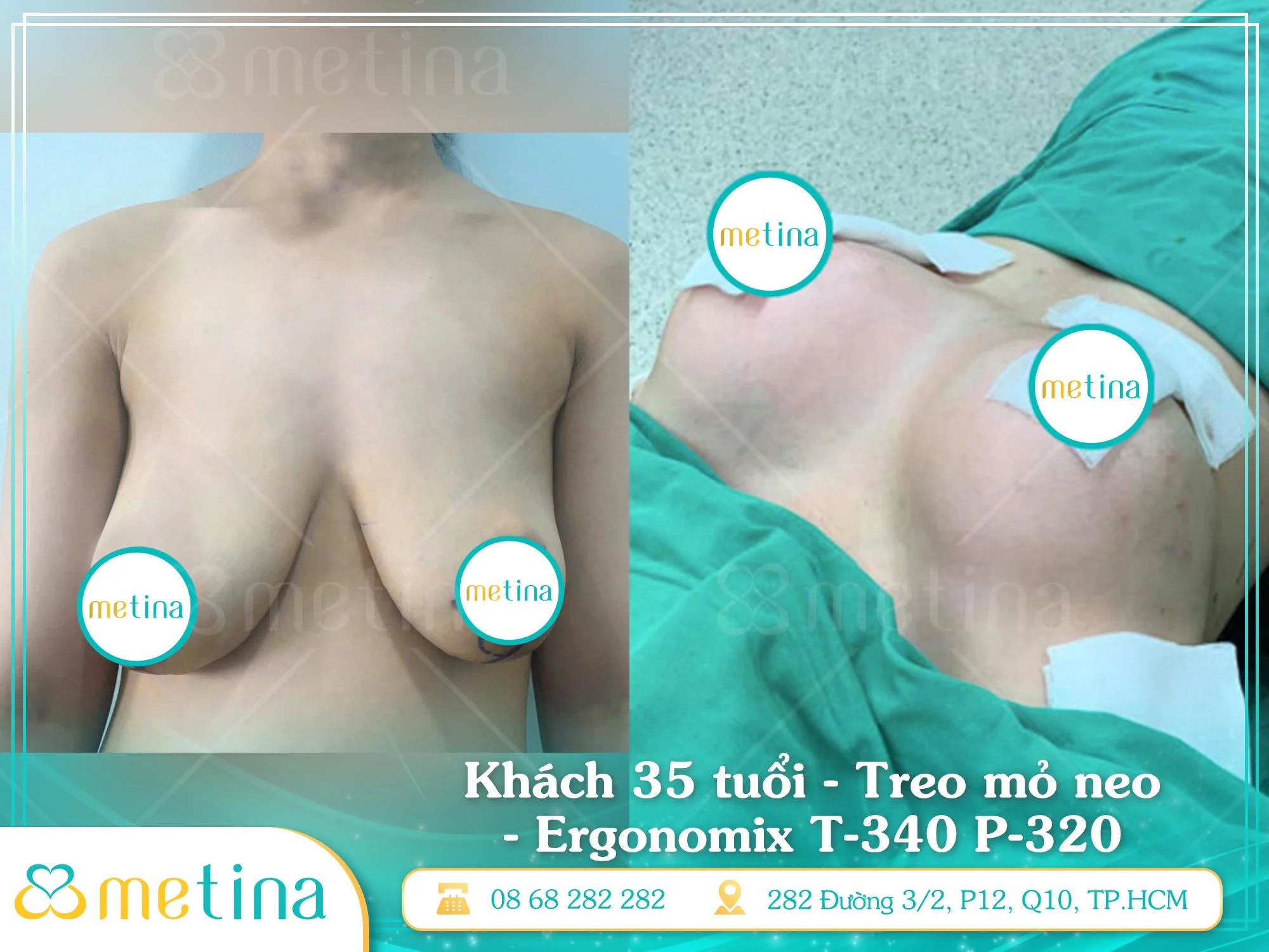 Tình trạng ngực sa trễ được khắc phục sau khi nâng ngực tại phòng khám Dr. Châu Thanh Phong