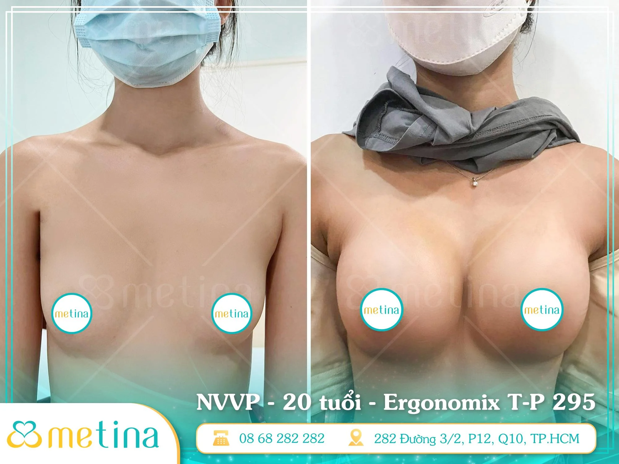 Hình ảnh vòng 1 trước - sau thực hiện phẫu thuật nâng ngực nội soi đường nách túi Ergonomix