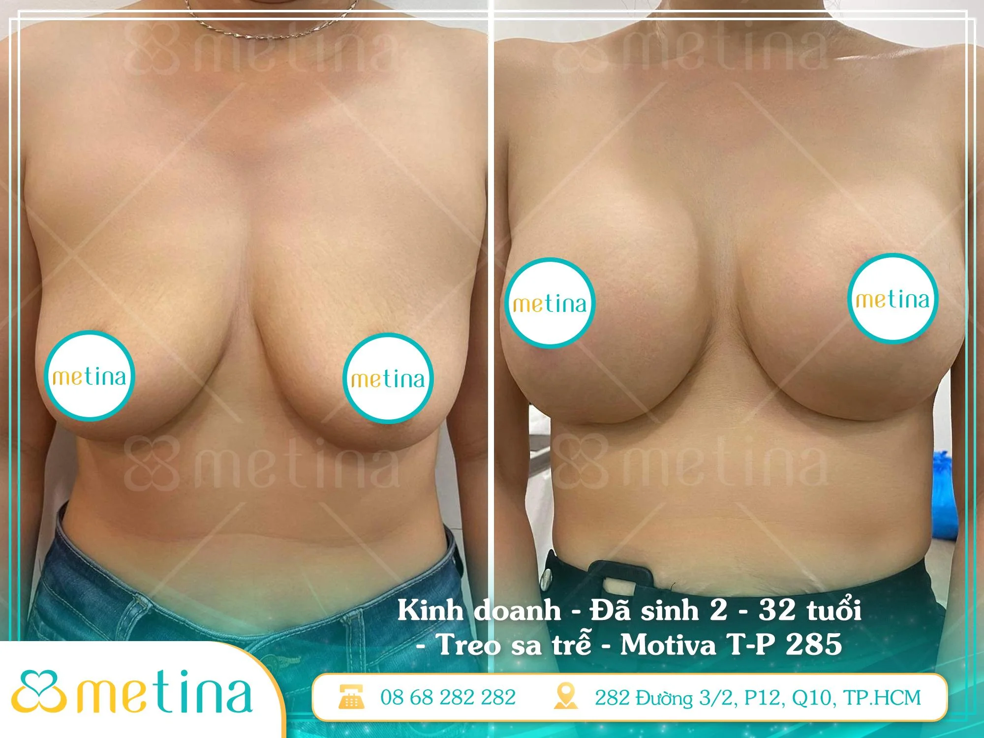 Khách hàng sở hữu vòng 1 “chuẩn đẹp” nhờ giải pháp treo sa trễ đường quầng túi Motiva