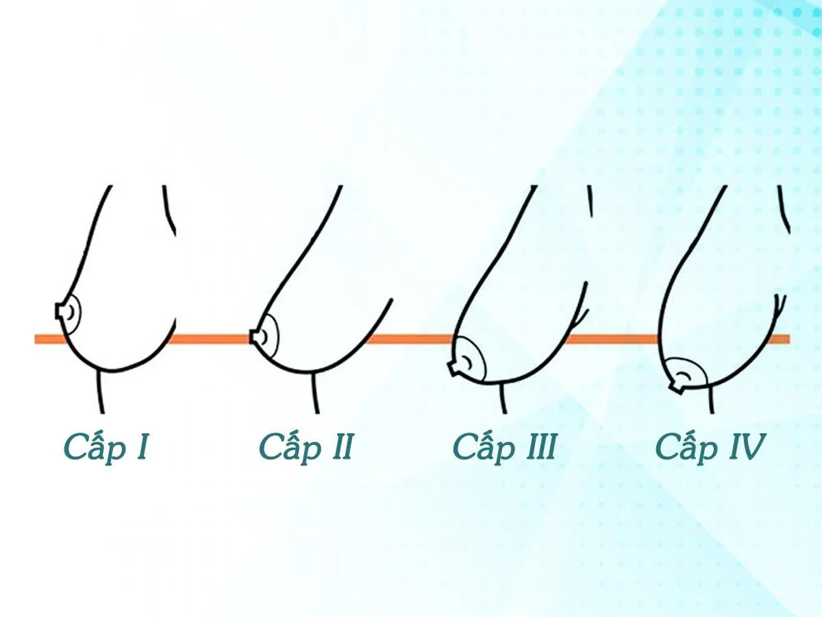 Các cấp độ sa trễ của ngực - Dr. Châu Thanh Phong - Thẩm mỹ 3 vòng