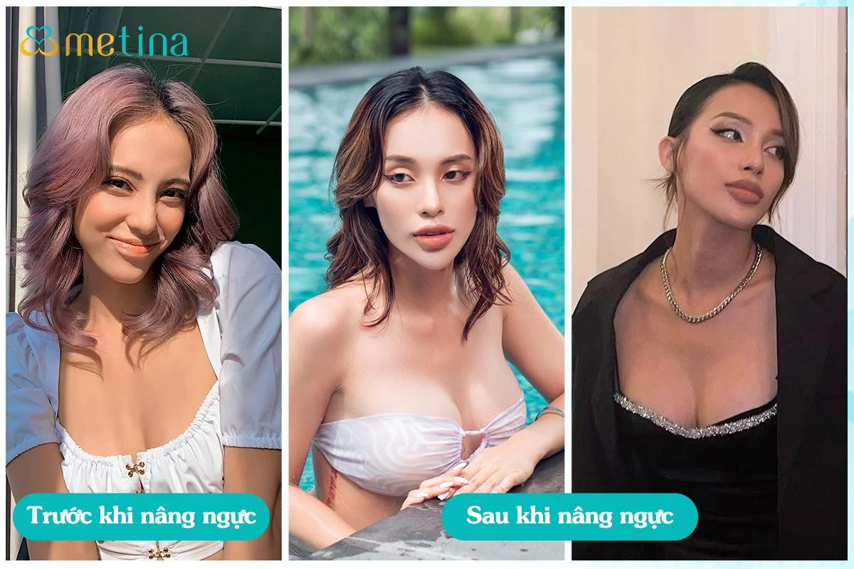 Hình ảnh diễn viên Vân Quỳnh trước và sau khi nâng ngực tại phòng khám Dr. Châu Thanh Phong - Dr. Châu Thanh Phong - Thẩm mỹ 3 vòng