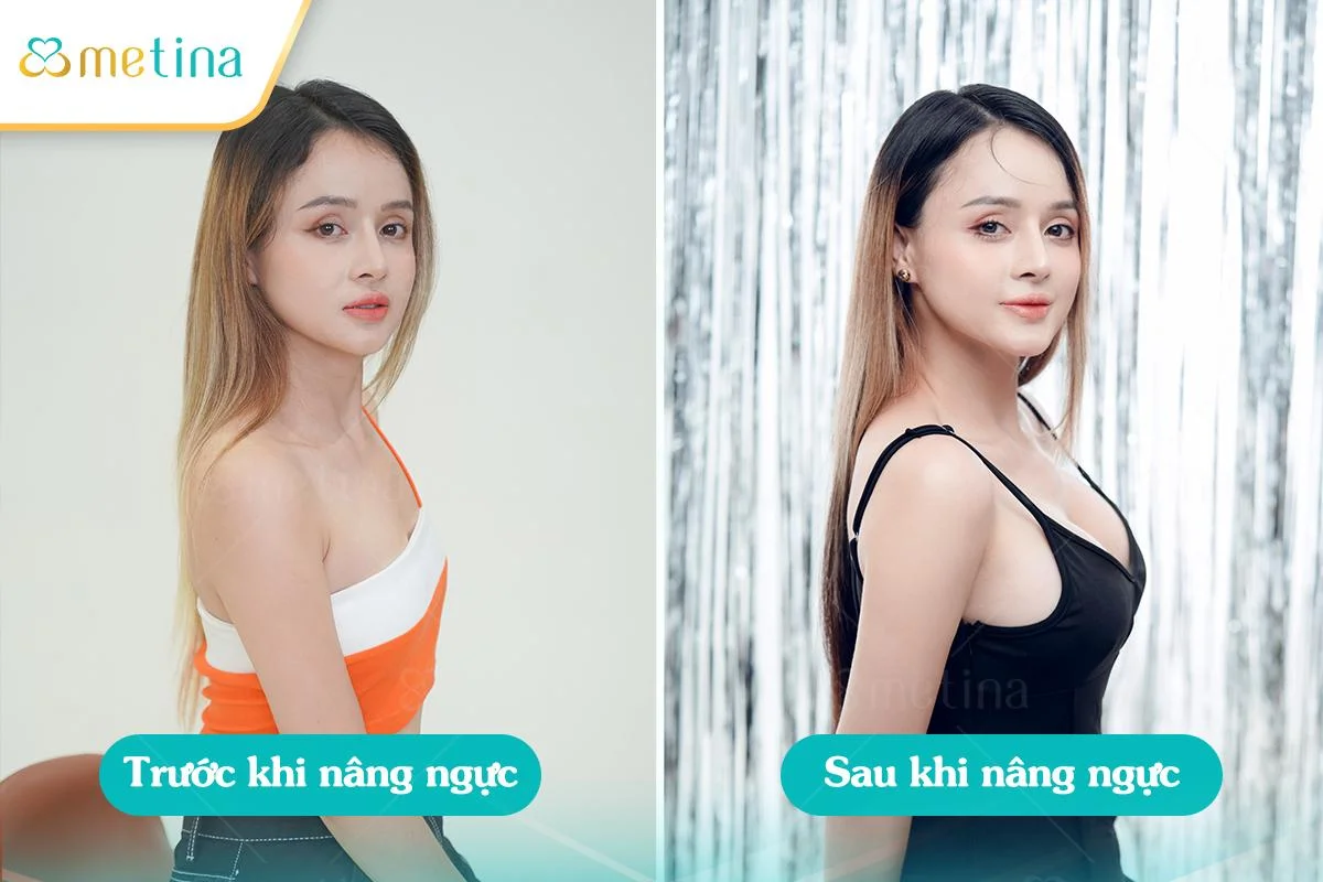 Nâng ngực giúp cân bằng hình dáng cơ thể - Dr. Châu Thanh Phong - Thẩm mỹ 3 vòng