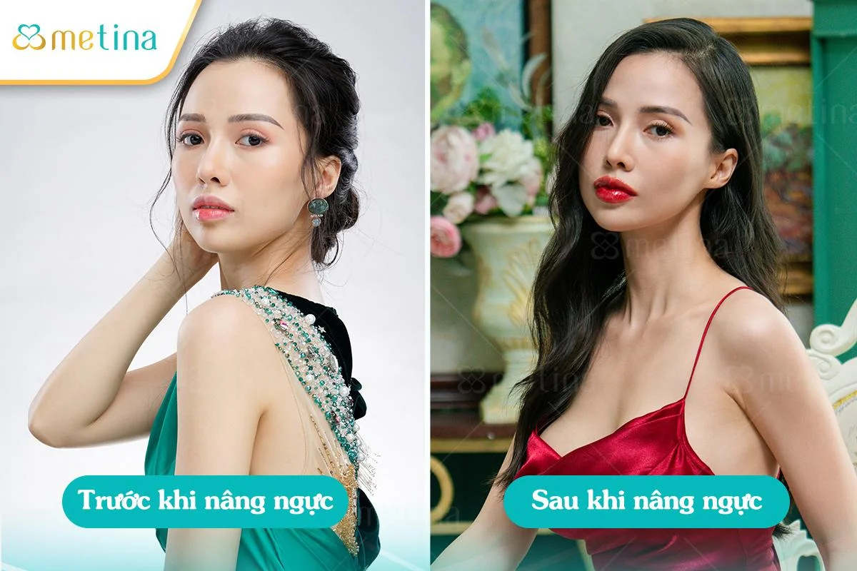 Mẹ bỉm L.P. phục hồi vòng 1 chảy xệ sau sinh tại phòng khám Dr. Châu Thanh Phong - Dr. Châu Thanh Phong - Thẩm mỹ 3 vòng