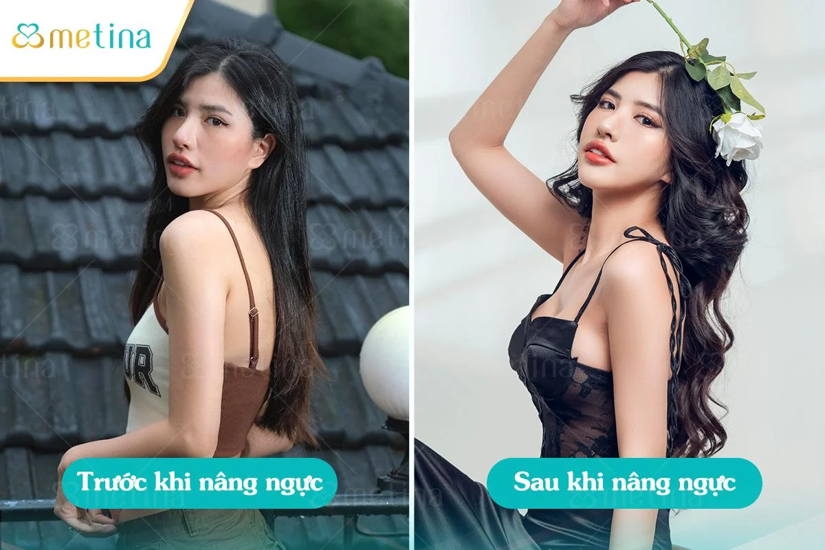 Nhân viên văn phòng 9X tự tin vào hình thể sau nâng ngực - Dr. Châu Thanh Phong - Thẩm mỹ 3 vòng