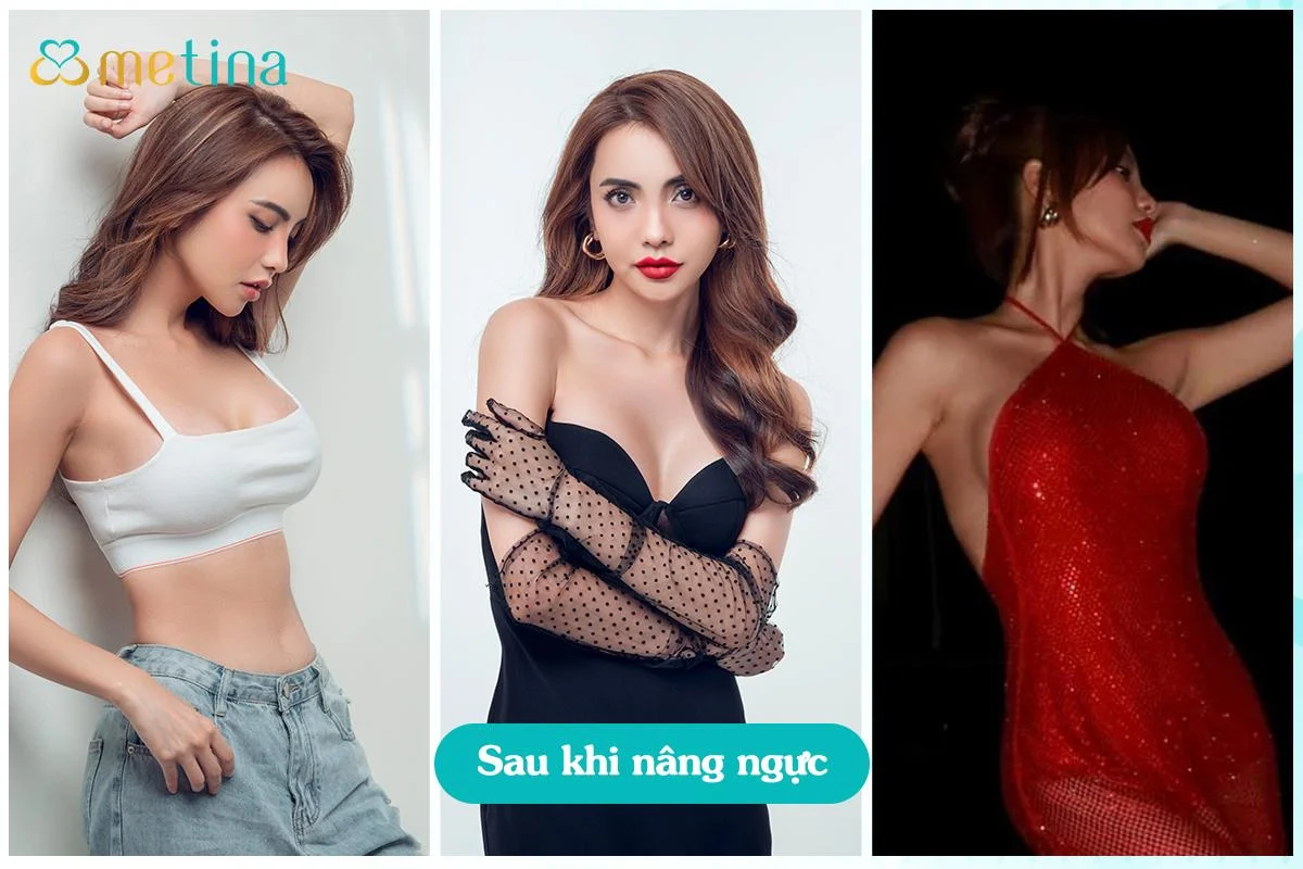 MC/Model Bùi Linh Chi sau khi nâng ngực tại phòng khám Dr. Châu Thanh Phong - Dr. Châu Thanh Phong - Thẩm mỹ 3 vòng
