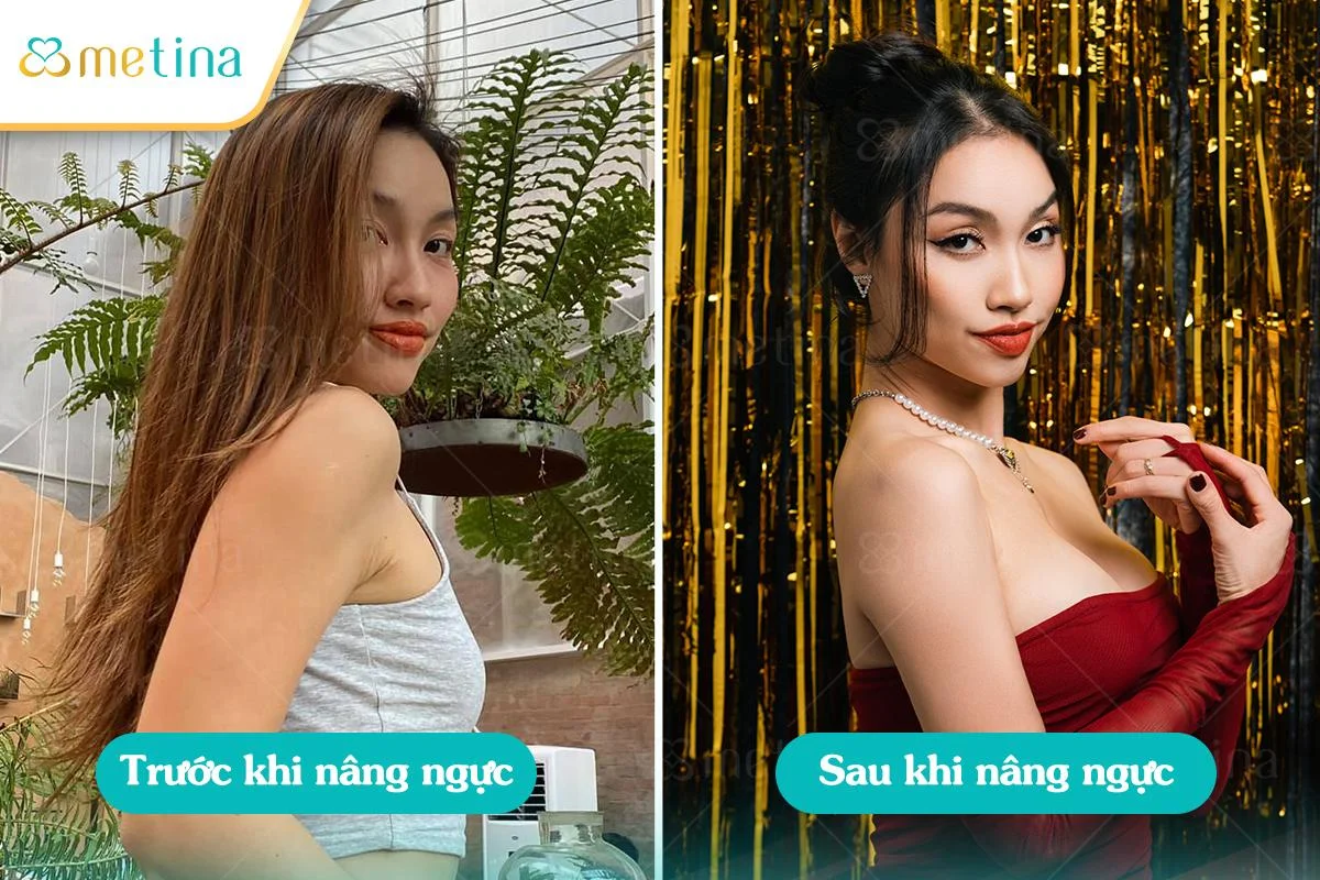 Hình ảnh vũ công Thùy Vân nâng cấp vòng 1 sau khi sinh - Dr. Châu Thanh Phong - Thẩm mỹ 3 vòng