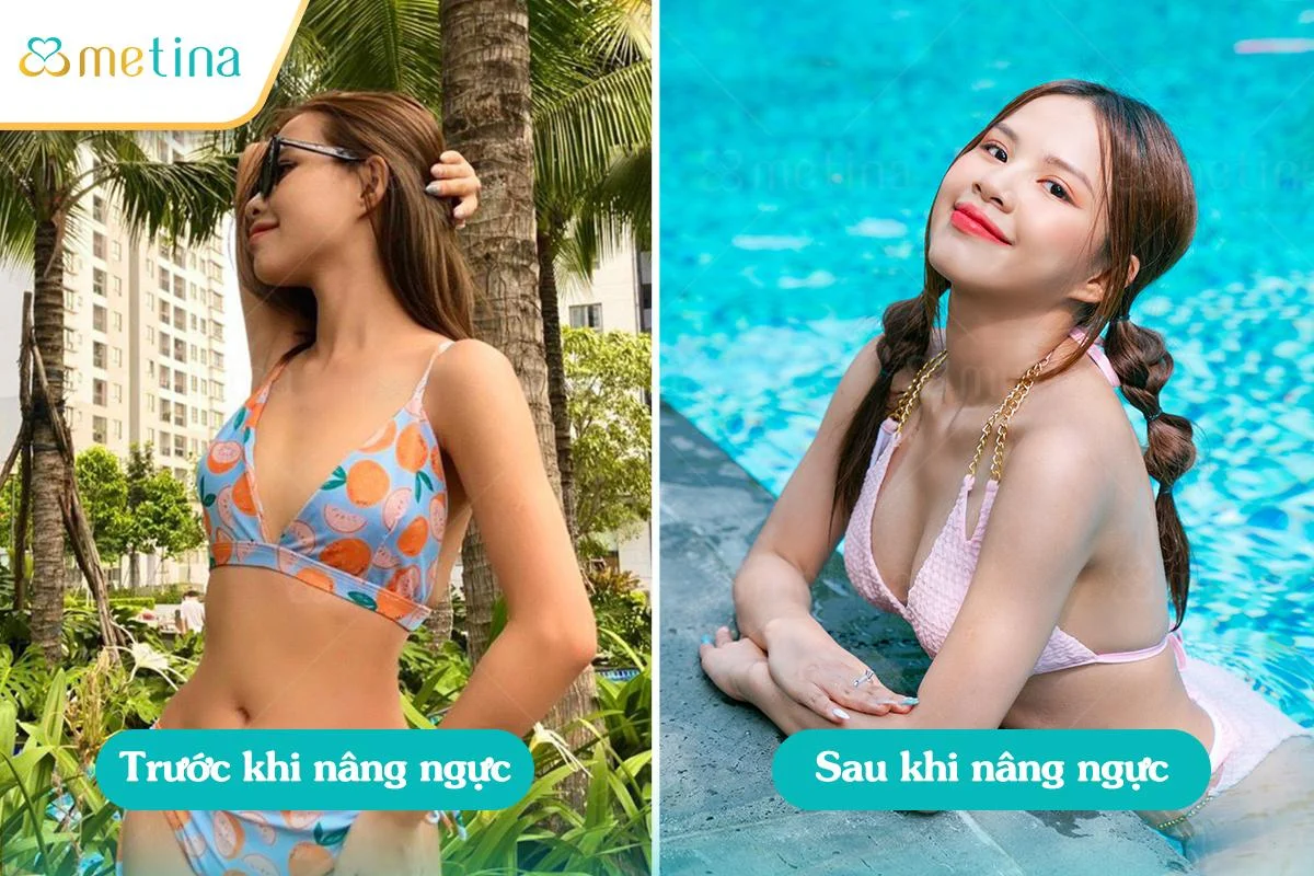 KOLs Ngô Hiếu Hiệp tự tin khoe dáng cùng bikini sau khi nâng ngực - Dr. Châu Thanh Phong - Thẩm mỹ 3 vòng