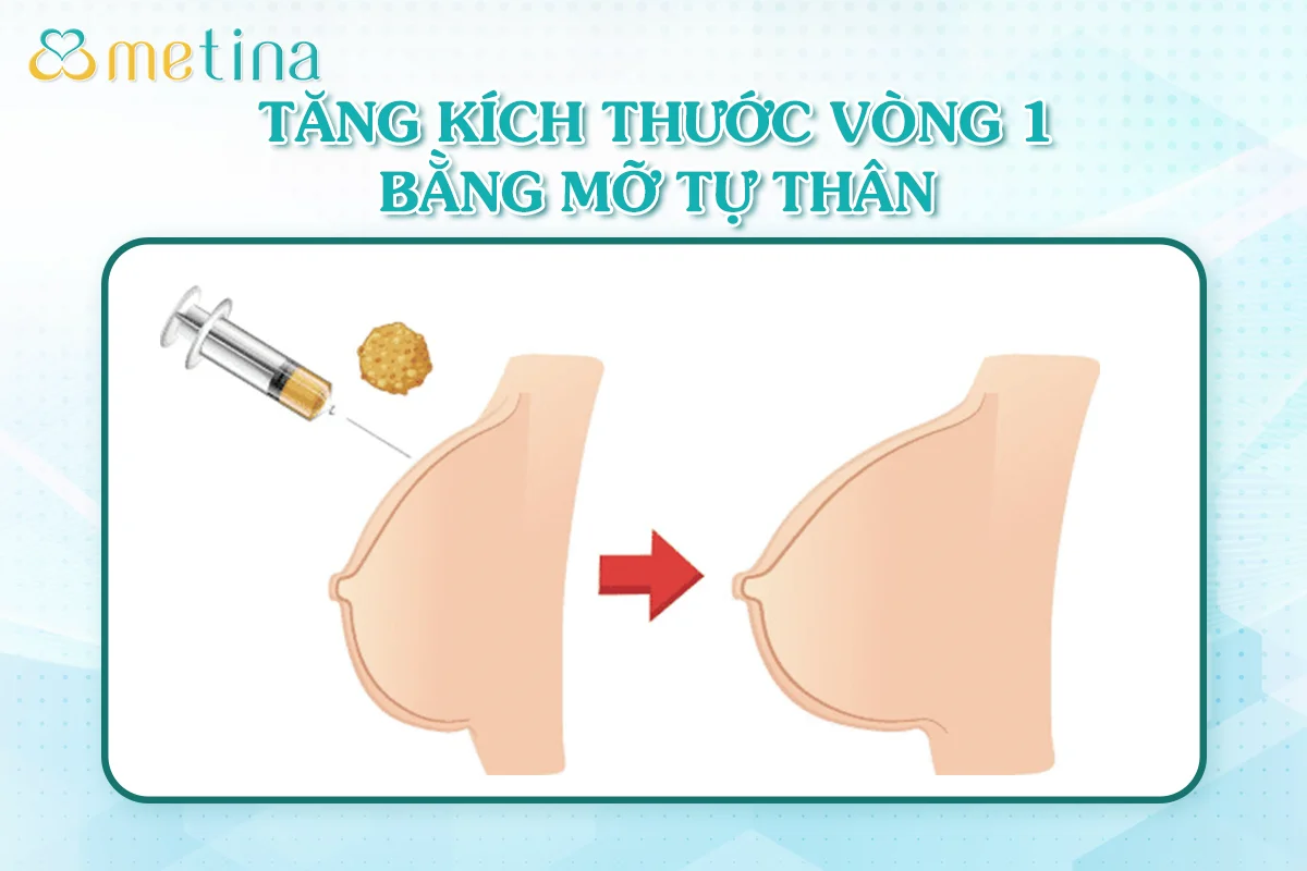 5 cách cải thiện vòng 1 chị em không nên bỏ qua - Dr. Châu Thanh Phong - Thẩm mỹ 3 vòng