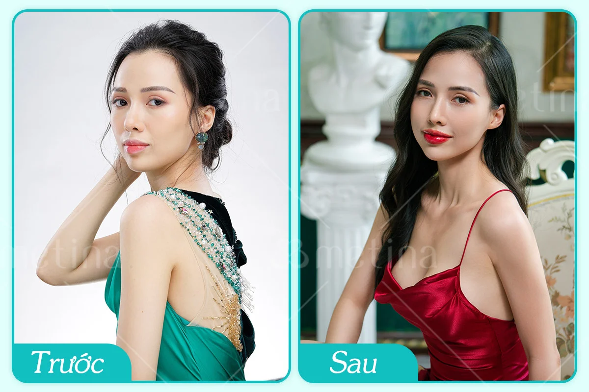 Mẹ bỉm 2 con L.P. trước và sau khi nâng ngực tại phòng khám Dr. Châu Thanh Phong - Dr. Châu Thanh Phong - Thẩm mỹ 3 vòng