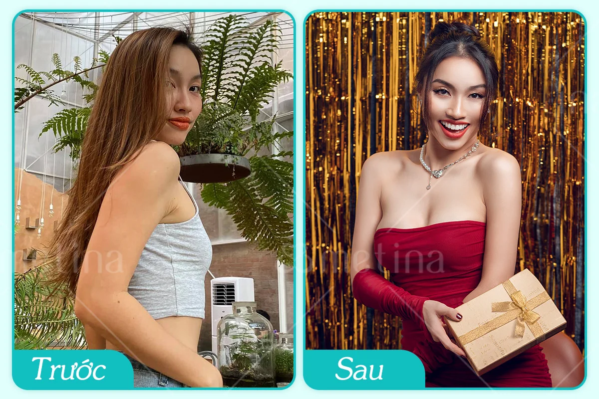 Vũ công Thùy Vân khoe body nóng bỏng sau 2 tháng nâng ngực - Dr. Châu Thanh Phong - Thẩm mỹ 3 vòng