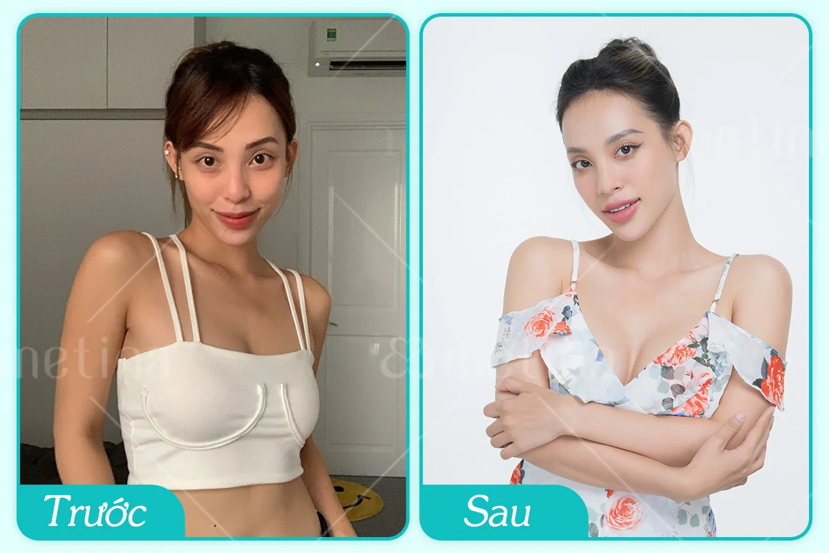 Chăm sóc hậu phẫu tốt giúp diễn viên Vân Quỳnh sở hữu form ngực đẹp sau 7 thá... - Dr. Châu Thanh Phong - Thẩm mỹ 3 vòng