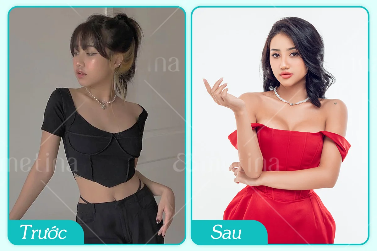 Diễn viên Trịnh Thảo trước và sau khi nâng ngực nội soi tại phòng khám Dr. Châu Thanh Phong - Dr. Châu Thanh Phong - Thẩm mỹ 3 vòng