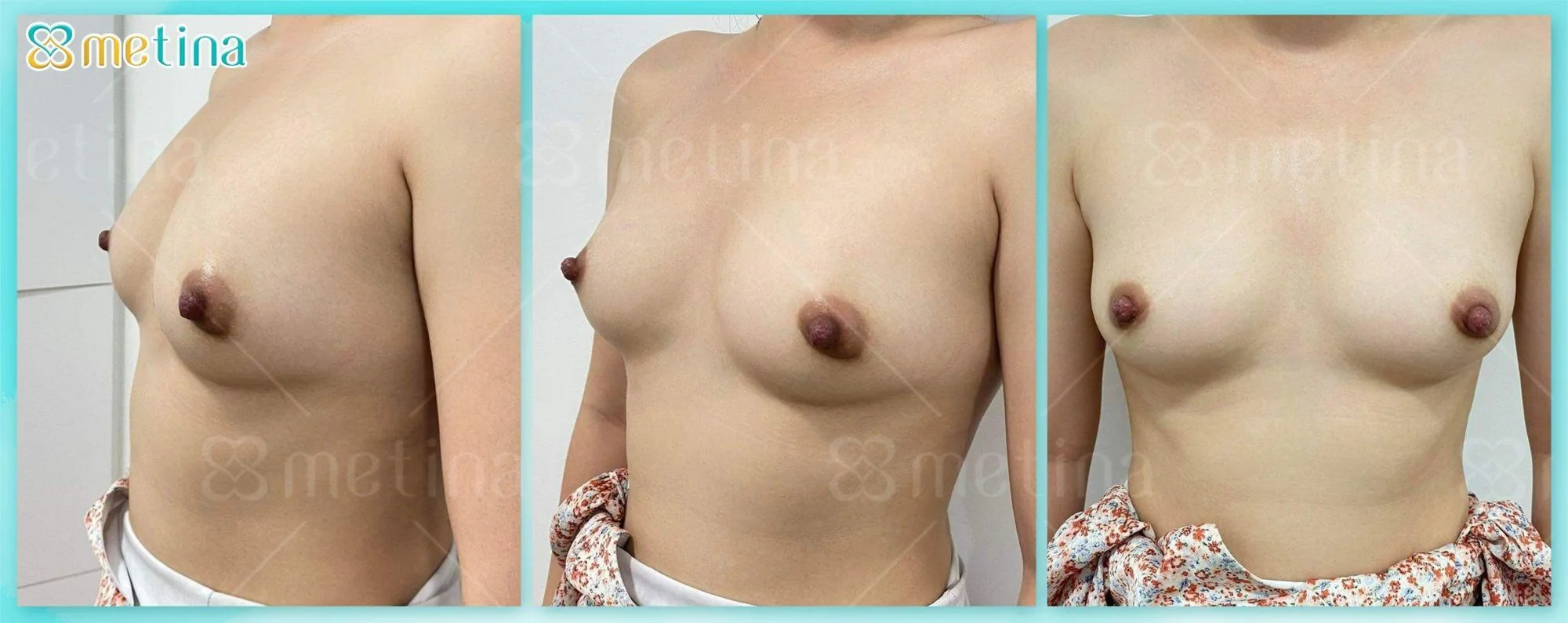 7 DÁNG NGỰC PHỔ BIẾN NHẤT - Dr. Châu Thanh Phong - Thẩm mỹ 3 vòng
