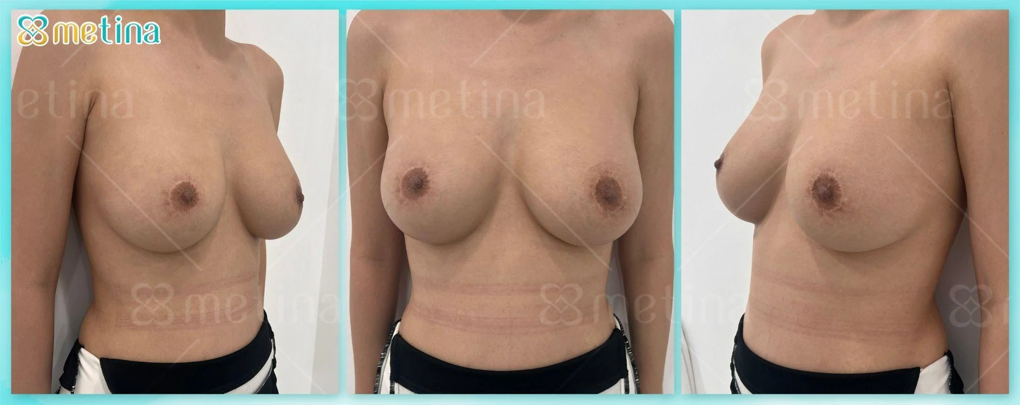 7 DÁNG NGỰC PHỔ BIẾN NHẤT - Dr. Châu Thanh Phong - Thẩm mỹ 3 vòng