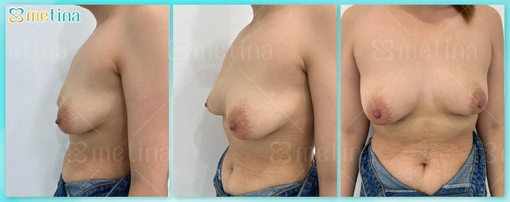 7 DÁNG NGỰC PHỔ BIẾN NHẤT - Dr. Châu Thanh Phong - Thẩm mỹ 3 vòng