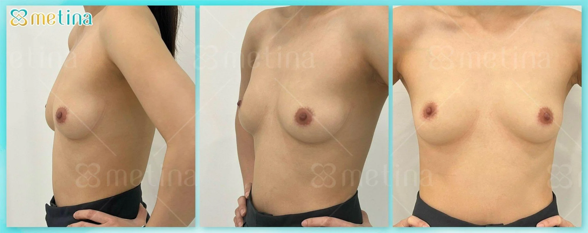 7 DÁNG NGỰC PHỔ BIẾN NHẤT - Dr. Châu Thanh Phong - Thẩm mỹ 3 vòng
