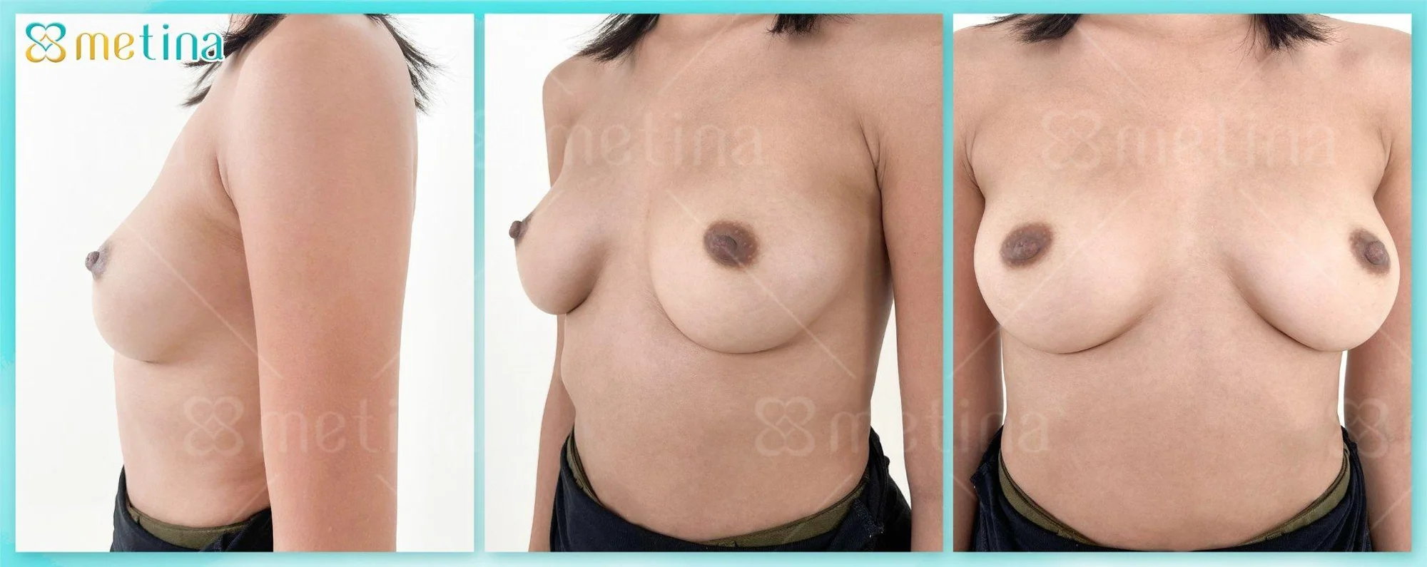 7 DÁNG NGỰC PHỔ BIẾN NHẤT - Dr. Châu Thanh Phong - Thẩm mỹ 3 vòng
