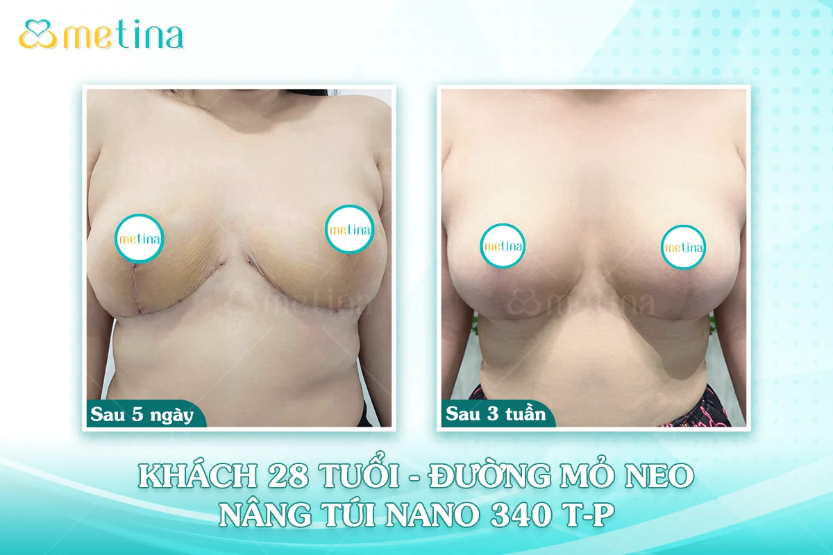 Cơ địa sẹo lồi có nâng ngực được không? - Dr. Châu Thanh Phong - Thẩm mỹ 3 vòng
