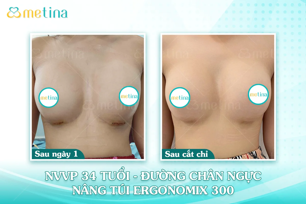 Cơ địa sẹo lồi có nâng ngực được không? - Dr. Châu Thanh Phong - Thẩm mỹ 3 vòng