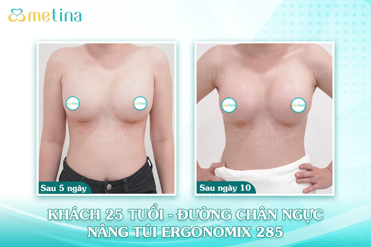 Cơ địa sẹo lồi có nâng ngực được không? - Dr. Châu Thanh Phong - Thẩm mỹ 3 vòng