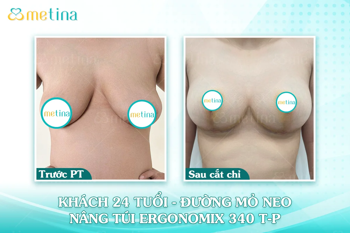 Cơ địa sẹo lồi có nâng ngực được không? - Dr. Châu Thanh Phong - Thẩm mỹ 3 vòng