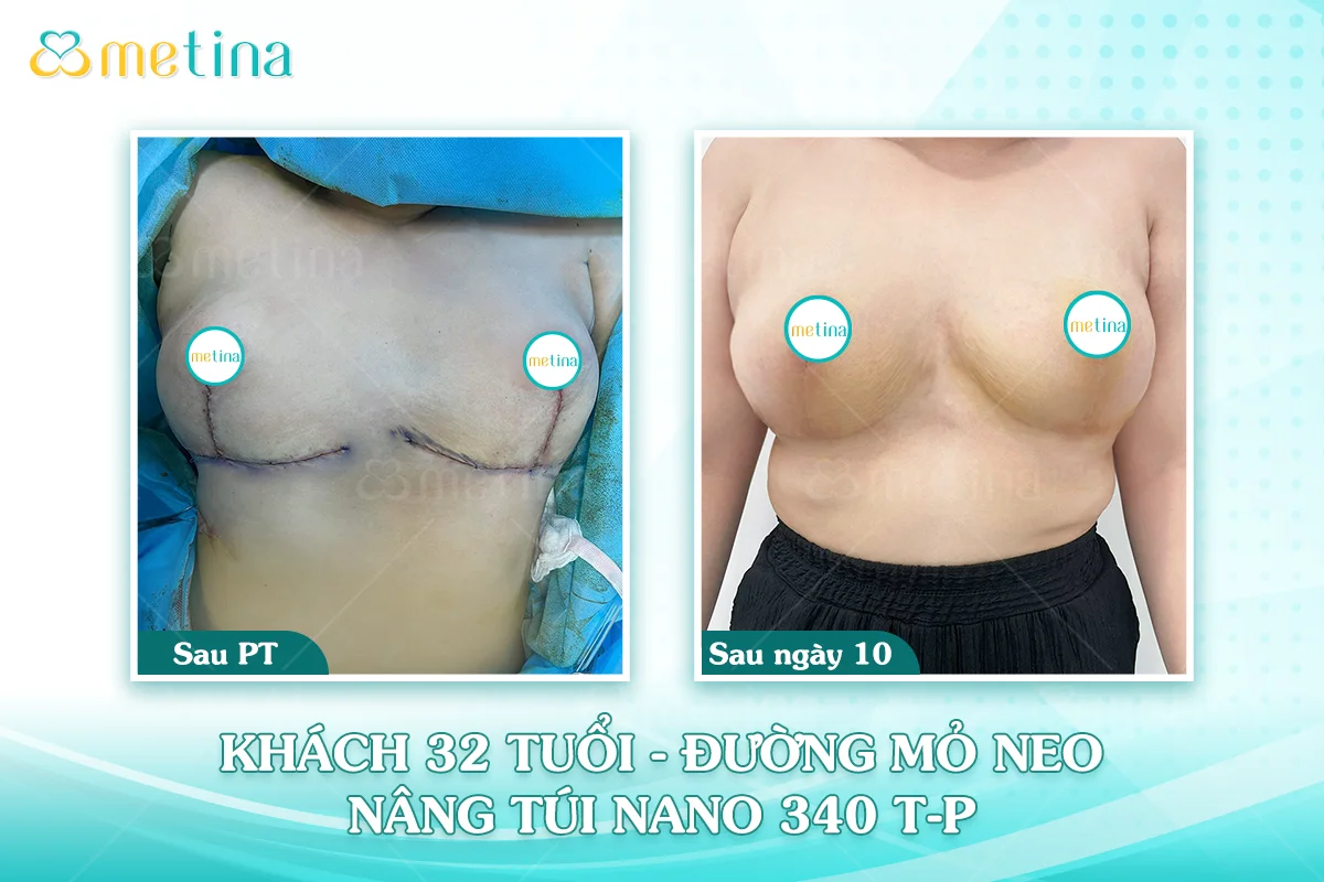 Cơ địa sẹo lồi có nâng ngực được không? - Dr. Châu Thanh Phong - Thẩm mỹ 3 vòng