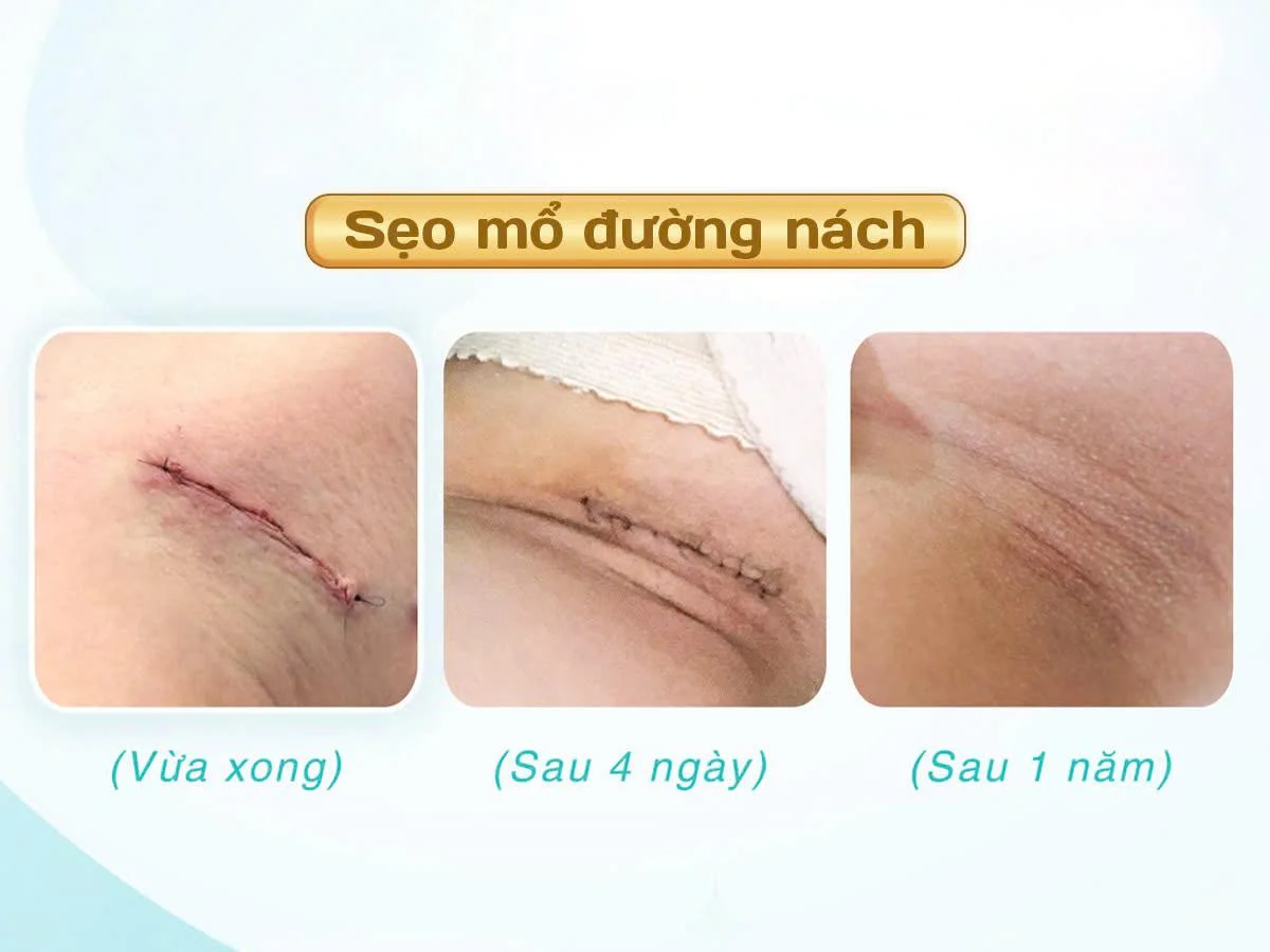 Tiến trình lành sẹo mổ đường nách khi sử dụng phương pháp nâng ngực nội soi -... - Dr. Châu Thanh Phong - Thẩm mỹ 3 vòng