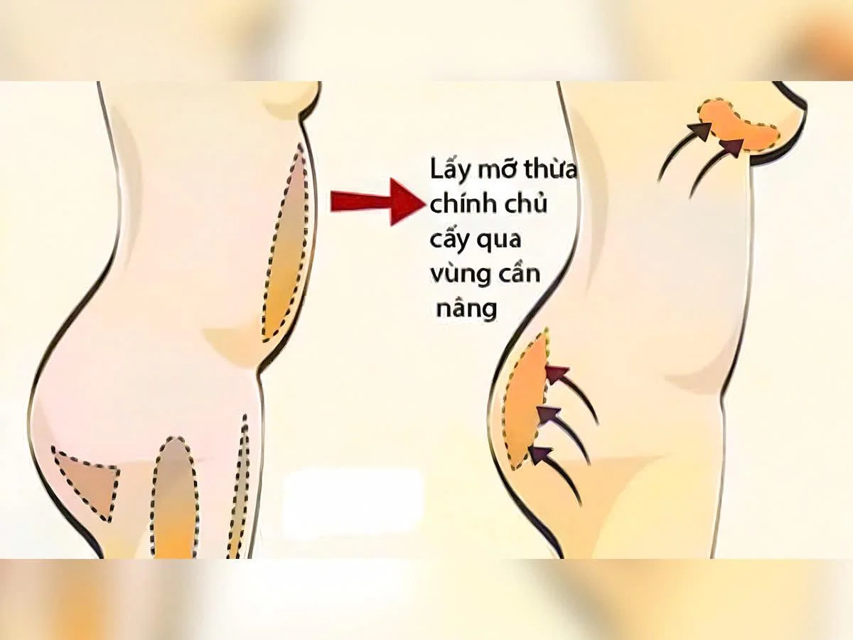 Cấy mỡ tự thân mang lại vẻ đẹp tự nhiên, an toàn hơn khi không gây dị ứng hay... - Dr. Châu Thanh Phong - Thẩm mỹ 3 vòng