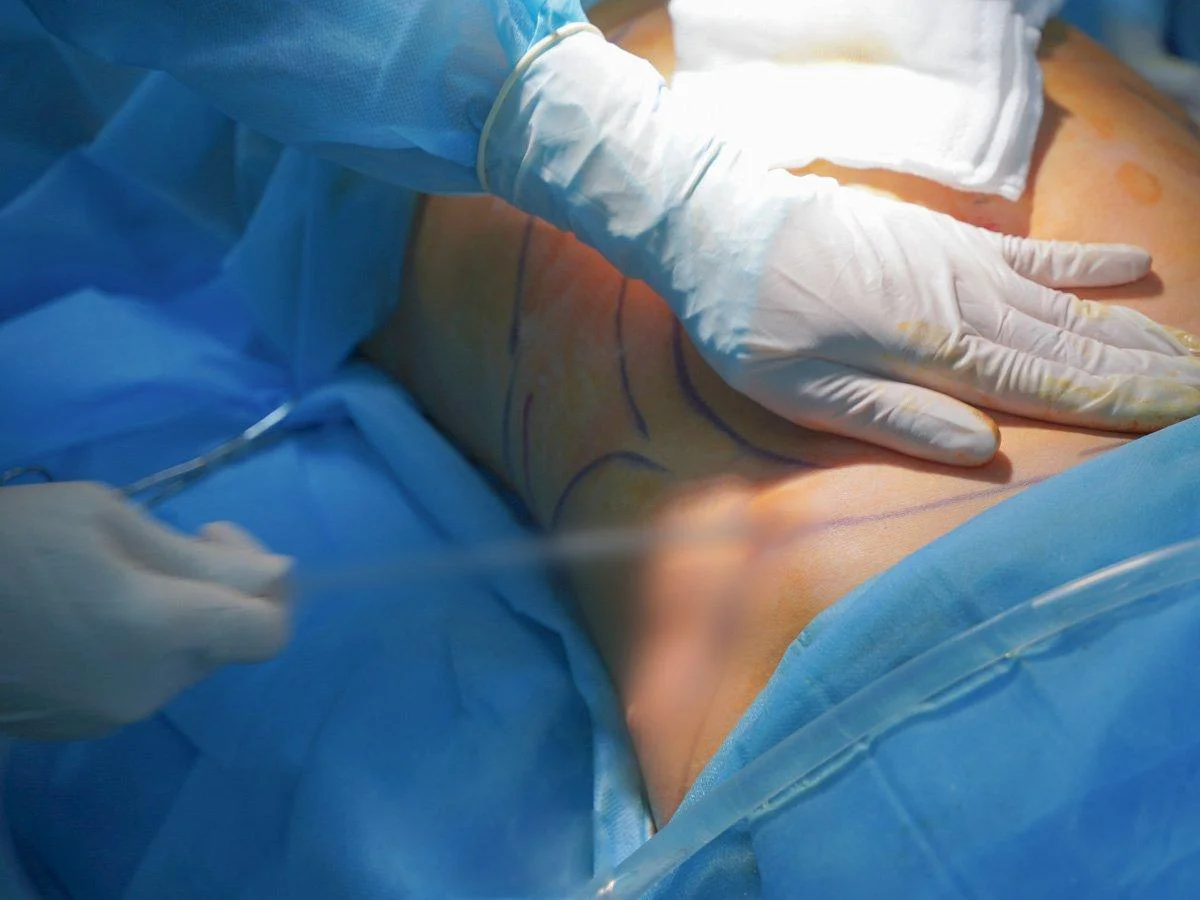 Hút mỡ không phải phương pháp giảm cân - Xin đừng hiểu lầm - Dr. Châu Thanh Phong - Thẩm mỹ 3 vòng
