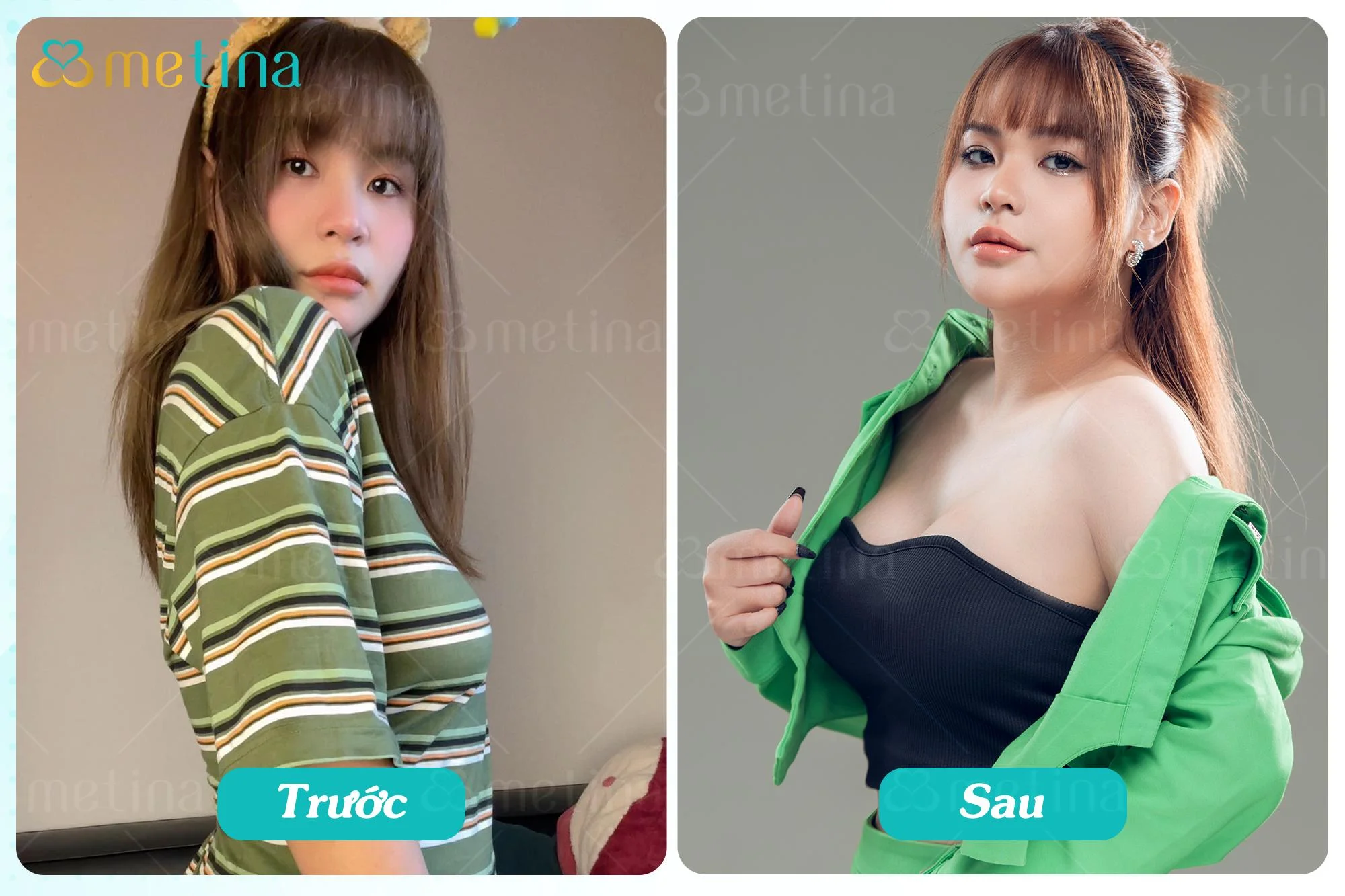 Hotmom Huỳnh Phụng trước và sau 1 tháng treo sa trễ độ 4 kết hợp đặt túi tại ... - Dr. Châu Thanh Phong - Thẩm mỹ 3 vòng