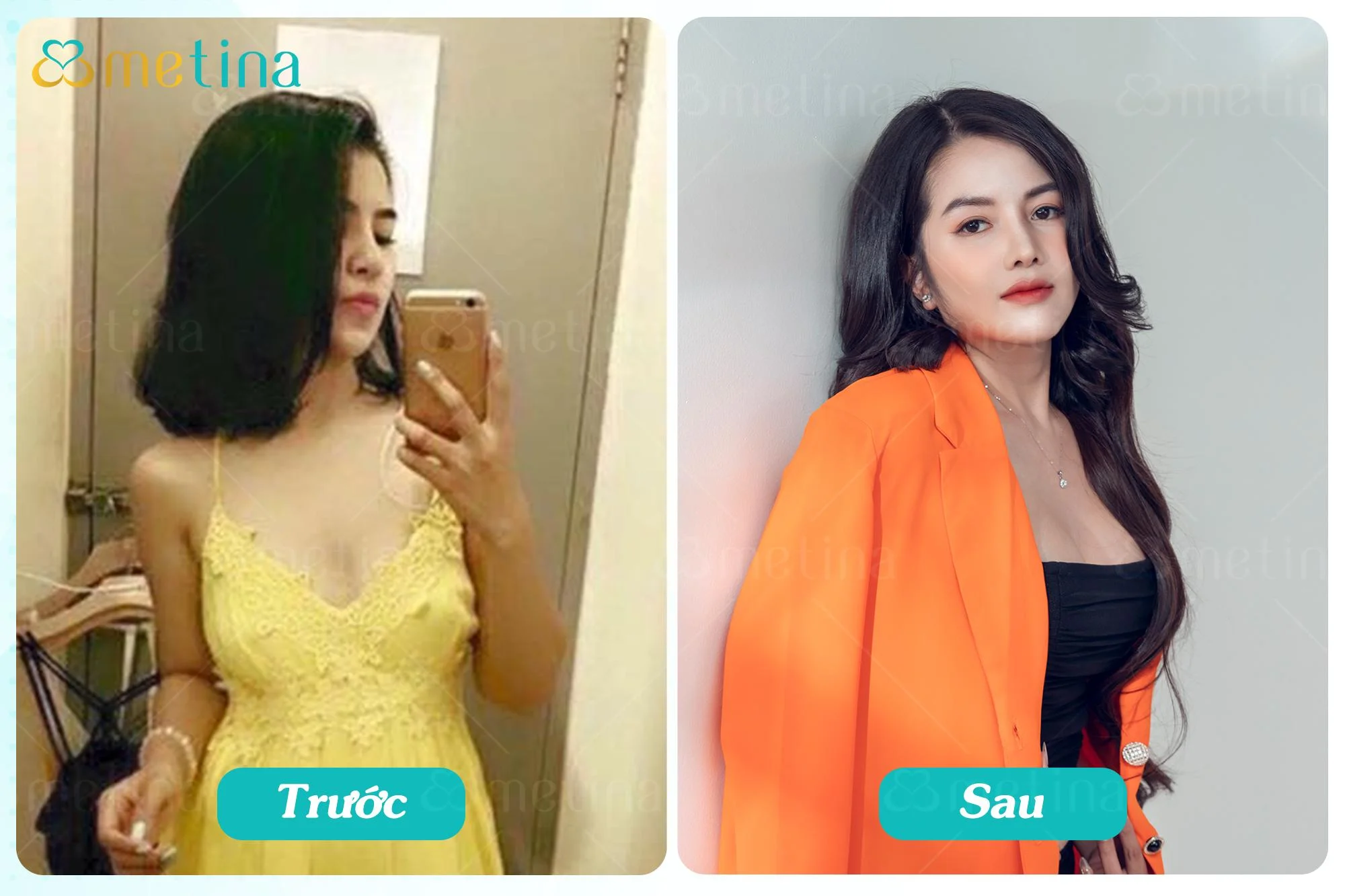 Thành quả sau 2 năm nâng ngực của khách hàng T.D. đến từ TP.HCM - Dr. Châu Thanh Phong - Thẩm mỹ 3 vòng