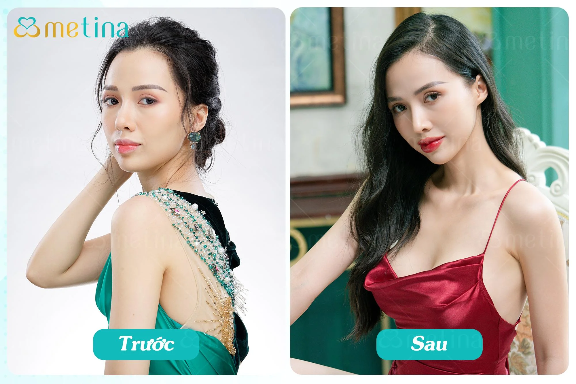 Mẹ bỉm L.P. tự tin khoe dáng sau 5 tháng nâng ngực kết hợp treo sa trễ - Dr. Châu Thanh Phong - Thẩm mỹ 3 vòng