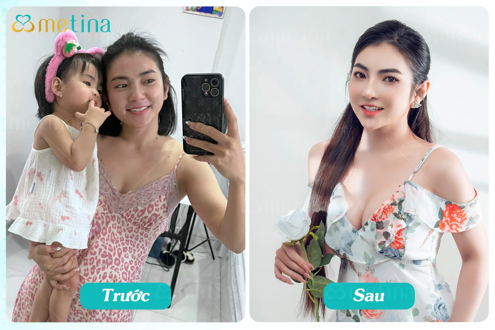 CEO Spa P.T. trước và sau 3 tháng treo sa trễ đường quầng kết hợp đặt túi - Dr. Châu Thanh Phong - Thẩm mỹ 3 vòng
