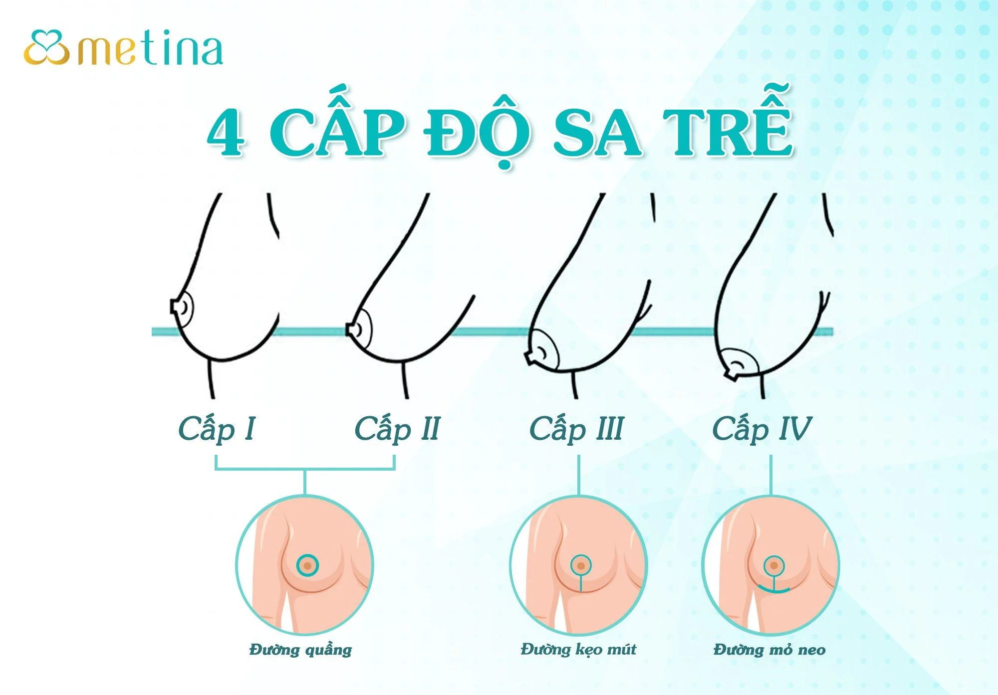 Các cấp độ và đường mổ tương ứng trong treo sa trễ theo bác sĩ CKI. Châu Than... - Dr. Châu Thanh Phong - Thẩm mỹ 3 vòng