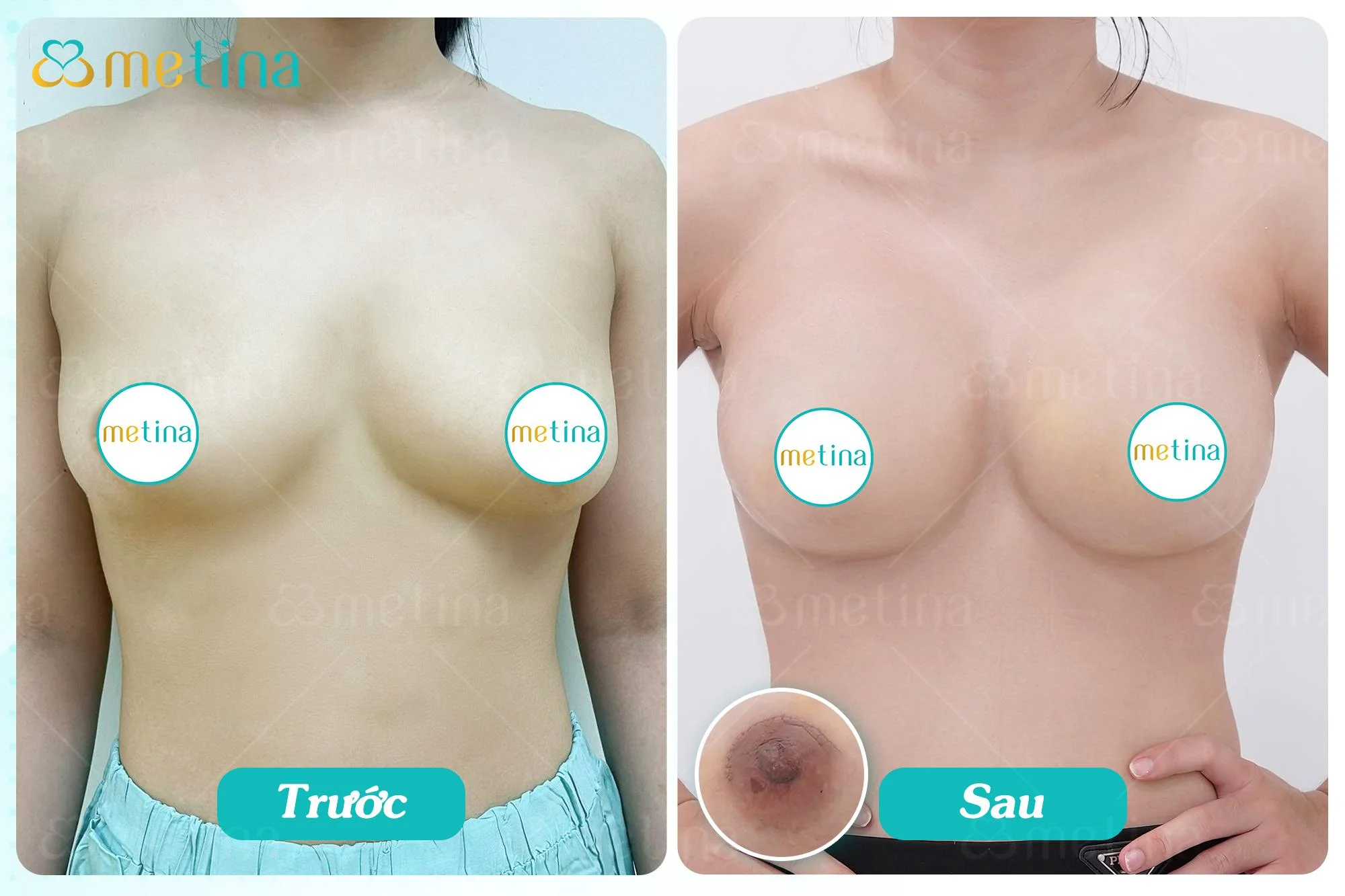 Hình ảnh sẹo đường quầng sau khi treo sa trễ độ 2 của chị P.T. - Dr. Châu Thanh Phong - Thẩm mỹ 3 vòng
