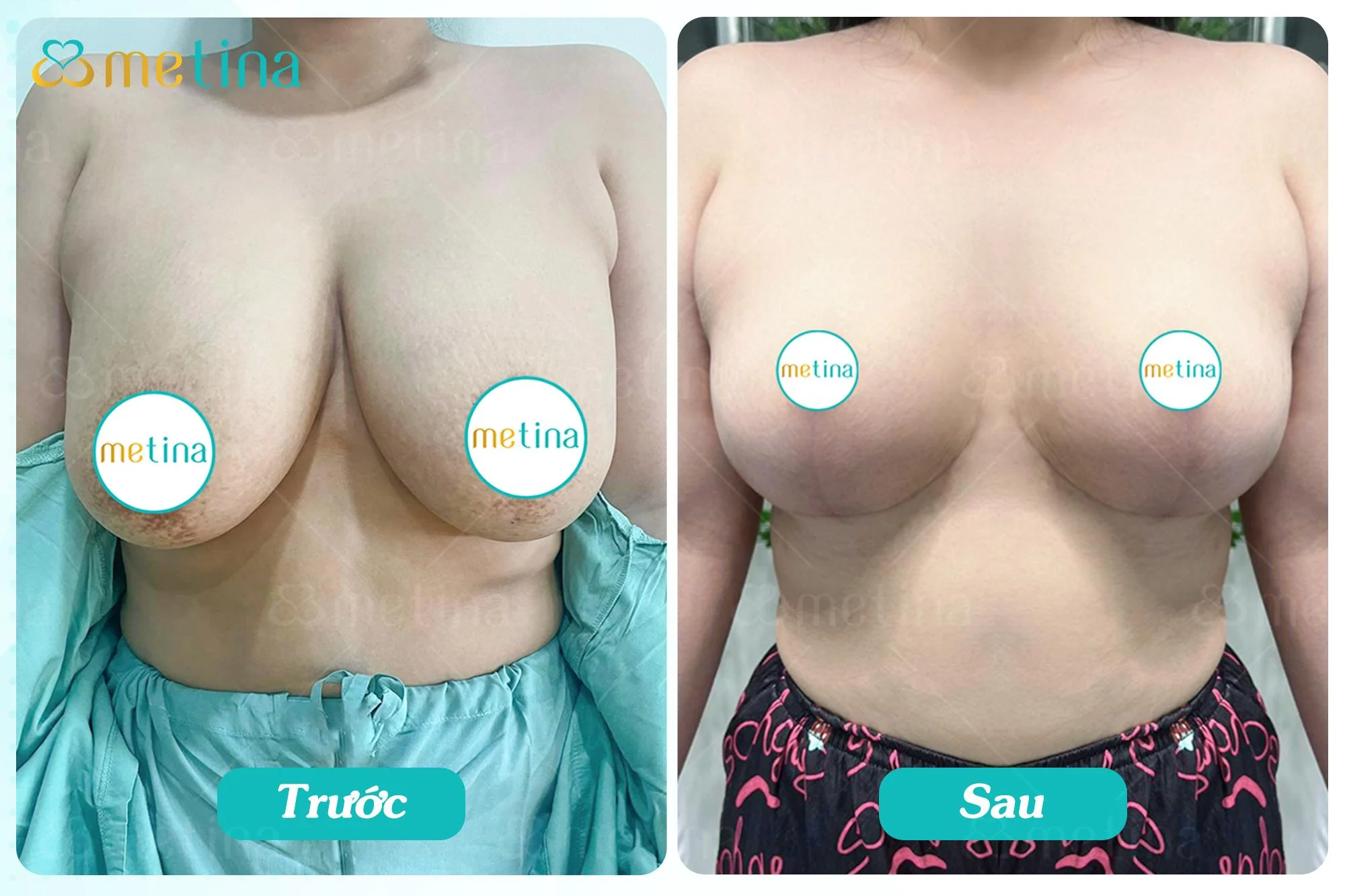 Hình ảnh sẹo của chị K.D. sau 3 tuần treo sa trễ độ 4, đường mỏ neo - Dr. Châu Thanh Phong - Thẩm mỹ 3 vòng