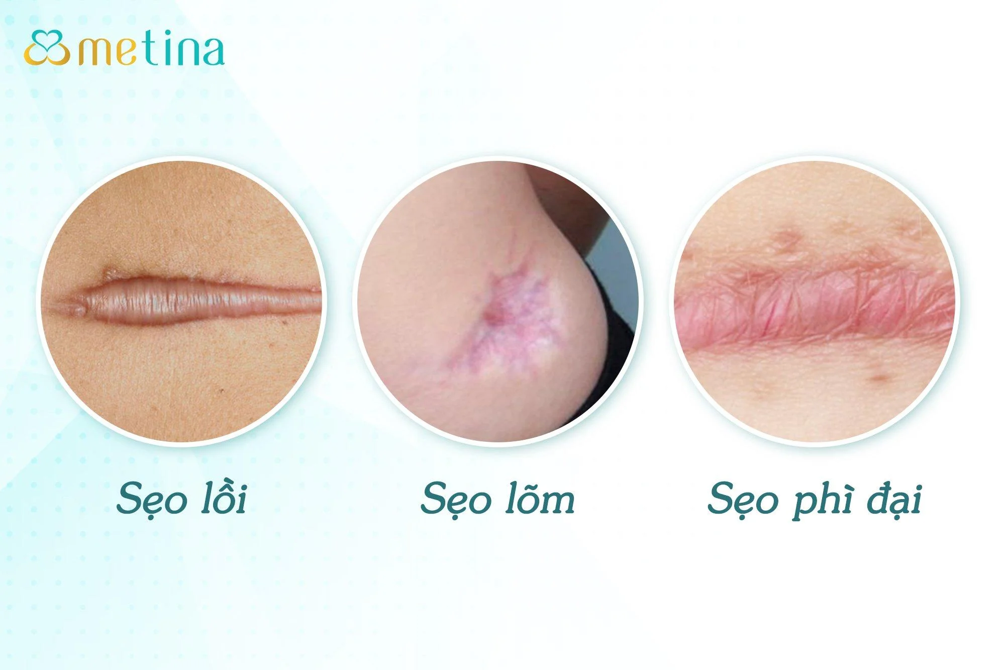 Các loại sẹo thường gặp sau khi treo sa trễ - Dr. Châu Thanh Phong - Thẩm mỹ 3 vòng