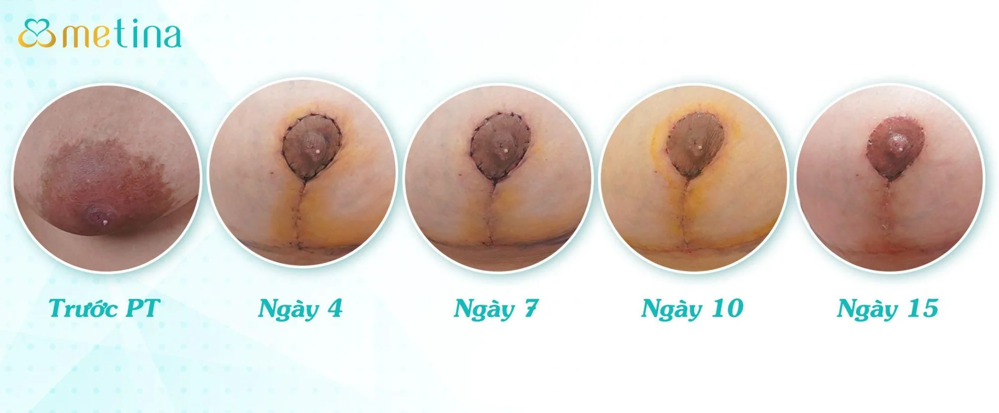 Kết quả quá trình chăm sóc sẹo đúng cách sau treo sa trễ đường mỏ neo - Dr. Châu Thanh Phong - Thẩm mỹ 3 vòng