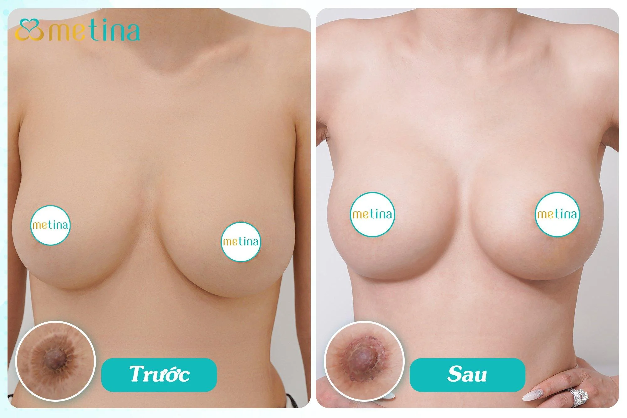 Hình ảnh sẹo của chị T.Th. sau khi treo sa trễ, thay túi mới và sửa sẹo tại M... - Dr. Châu Thanh Phong - Thẩm mỹ 3 vòng