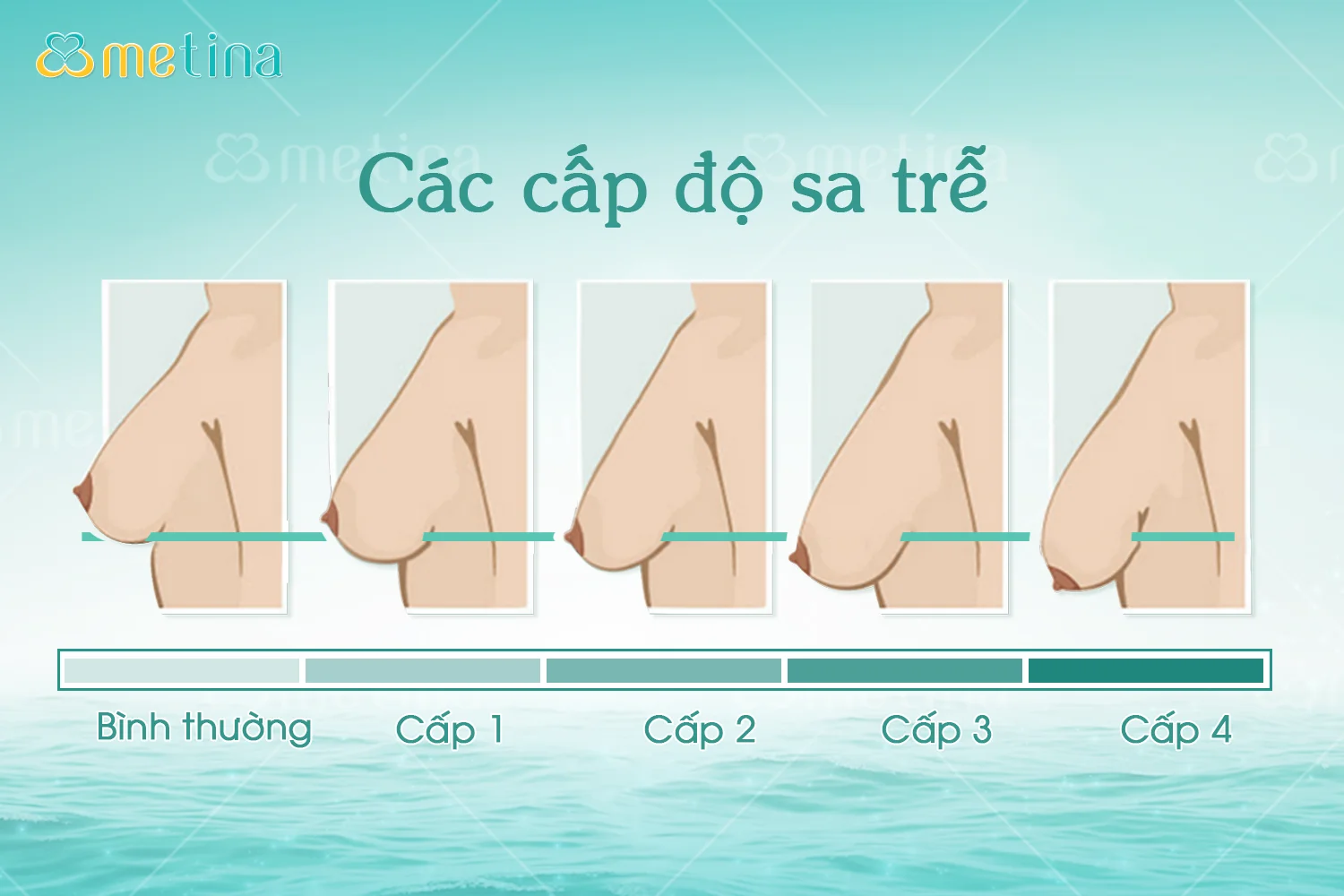 Treo sa trễ là gì? - Dr. Châu Thanh Phong - Thẩm mỹ 3 vòng