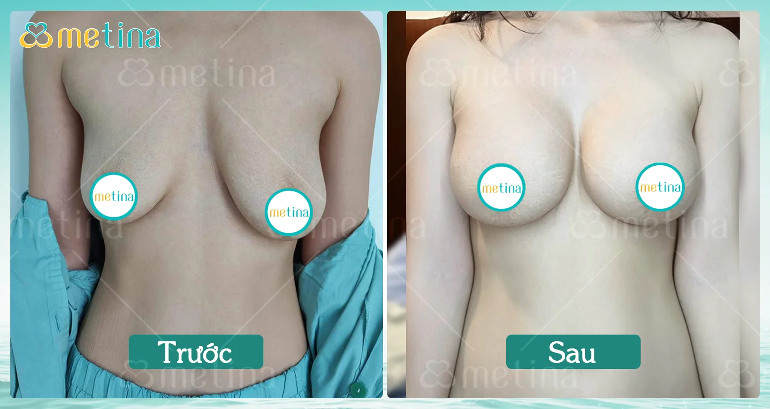 Treo sa trễ là gì? - Dr. Châu Thanh Phong - Thẩm mỹ 3 vòng