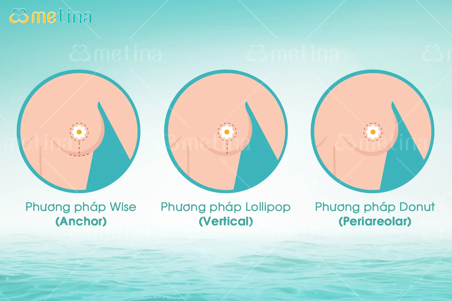 Treo sa trễ là gì? - Dr. Châu Thanh Phong - Thẩm mỹ 3 vòng