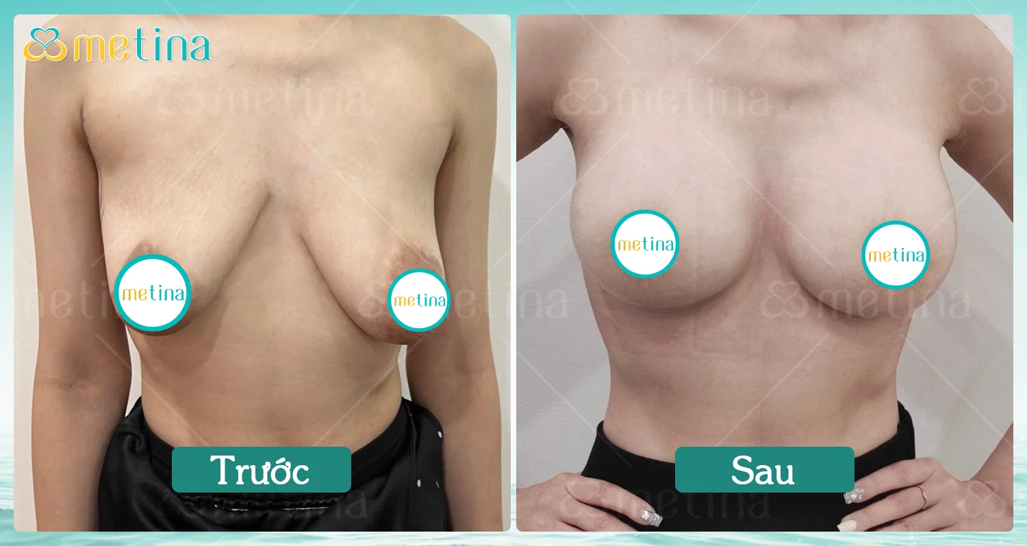Treo sa trễ là gì? - Dr. Châu Thanh Phong - Thẩm mỹ 3 vòng